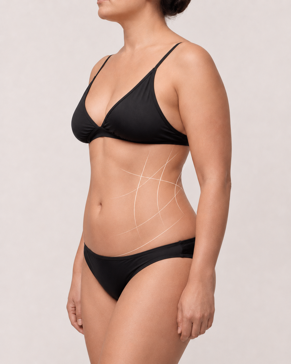 After liposuction body contouring result